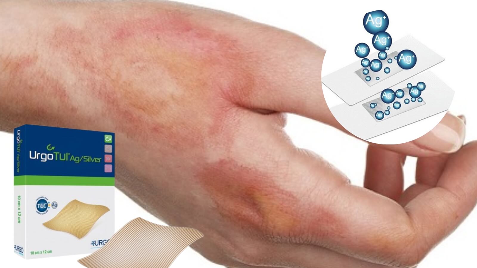 Các ion bạc của Urgotul Ag/Silver có hoạt tính kháng khuẩn giúp giảm nhiễm khuẩn tại chỗ