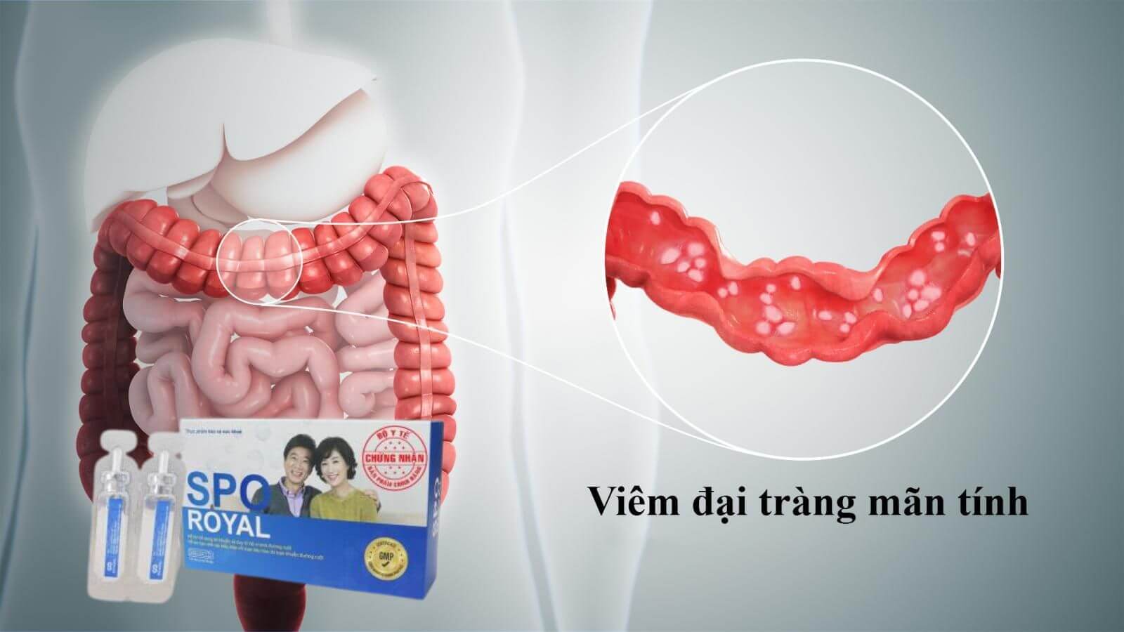 Men tiêu hóa Spo Royal Bào tử lợi khuẩn cho người viêm đại tràng