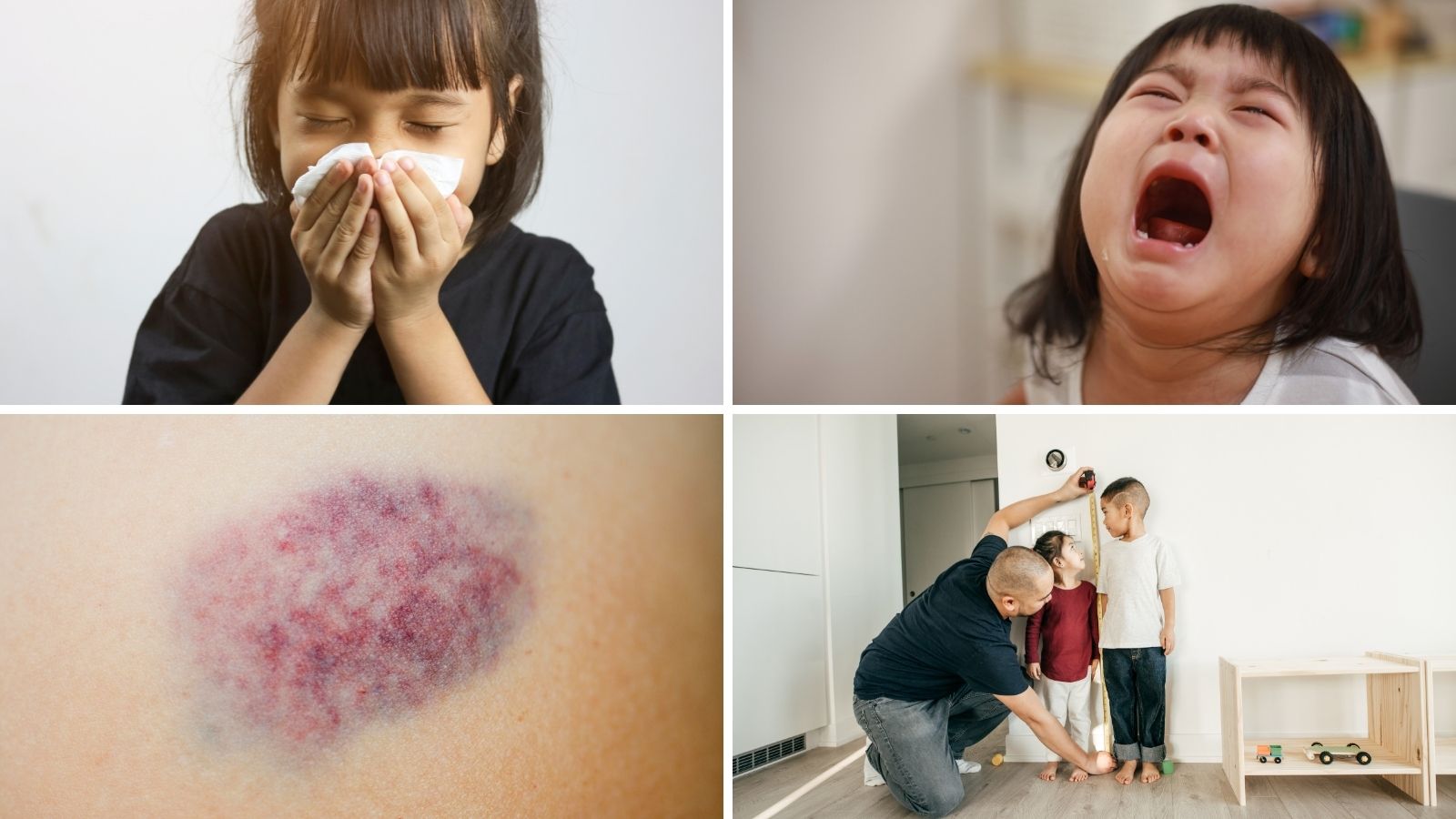 Một số dấu hiệu thường gặp khi thiếu vitamin khoáng chất ở trẻ nhỏ