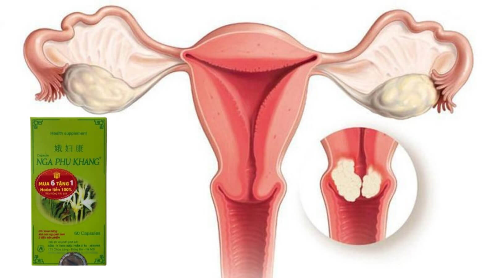 Viên uống Nga Phụ Khang giúp giảm kích thước khối u