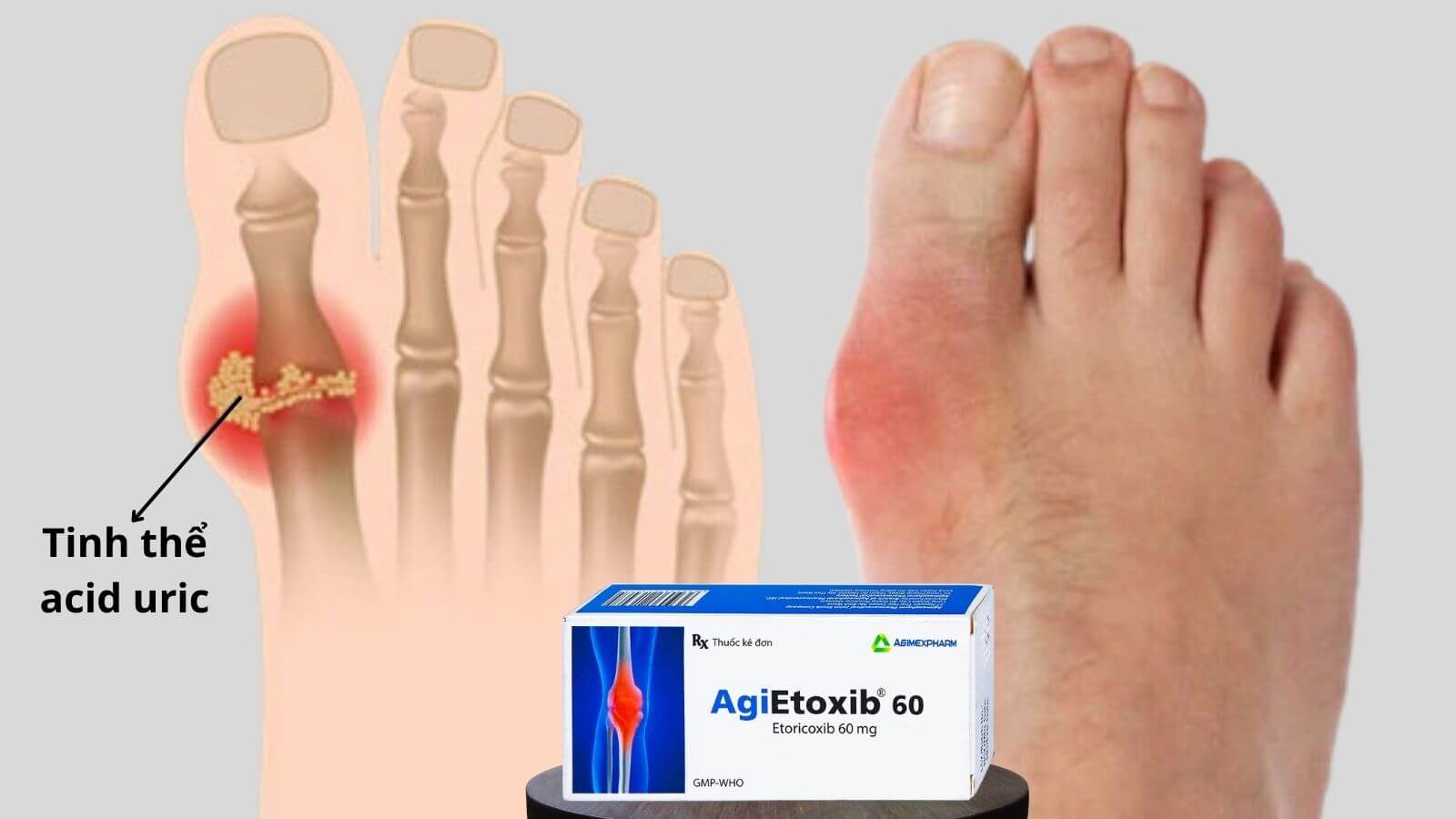 Agietoxib 60 giúp điều trị các cơn đau gout cấp tính
