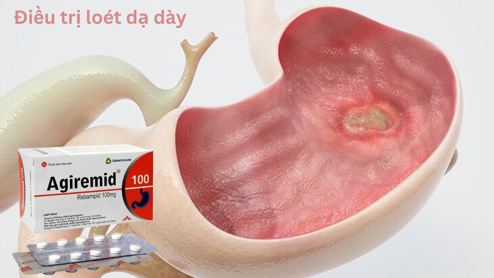 Thuốc Agiremid 100 giúp điều trị loét dạ dày hiệu quả