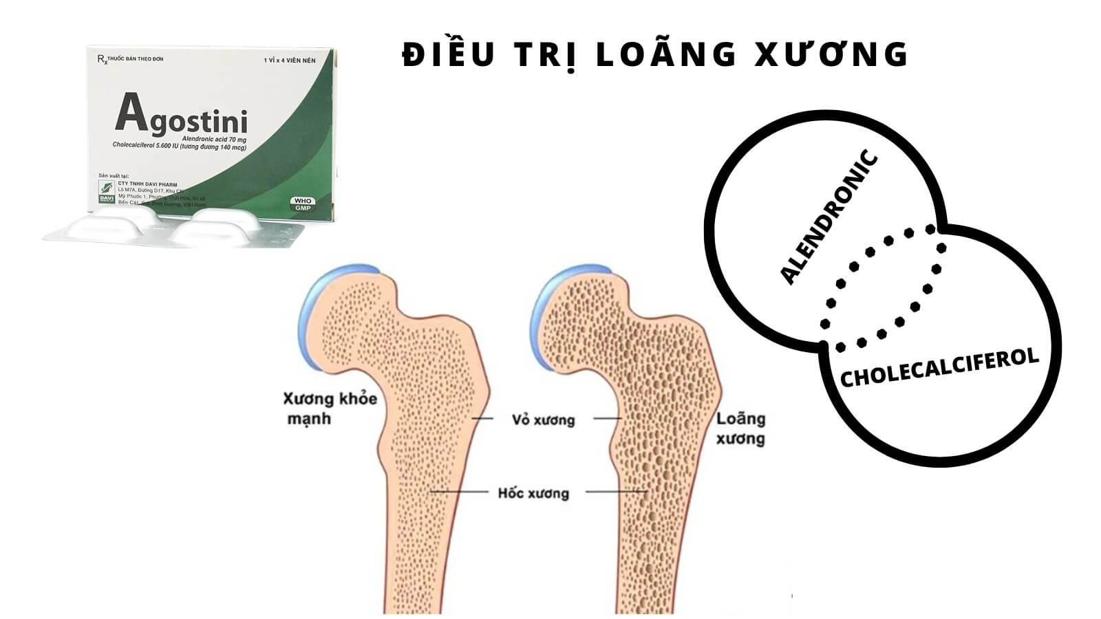 Agostini - Điều trị loãng xương sau mãn kinh