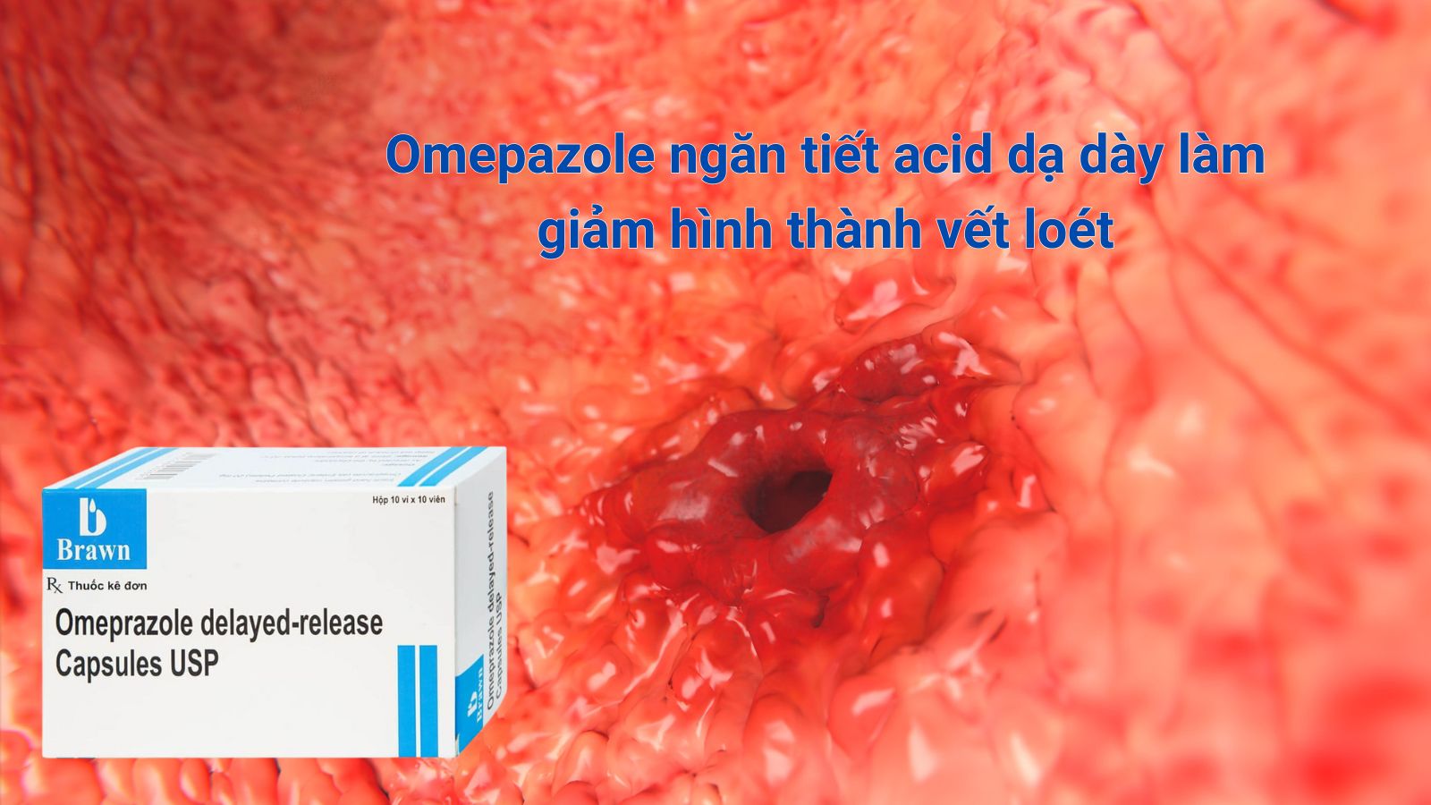 Omepazole ngăn tiết acid dạ dày làm giảm hình thành vết loét
