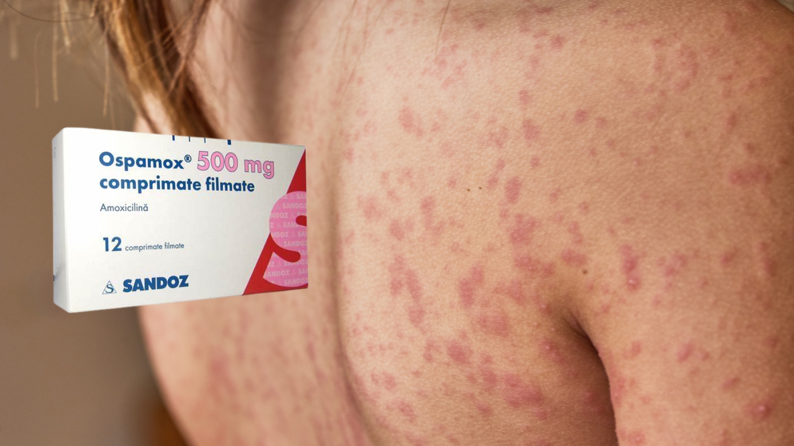 Ospamox 500mg điều trị hiệu quả các nhiễm trùng tại da và mô mềm 