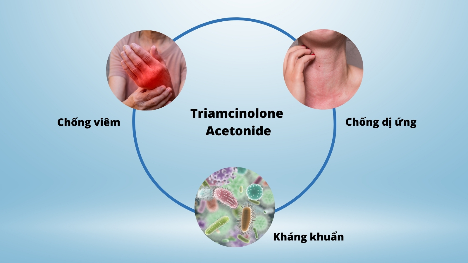 Triamcinolone acetonide là một corticosteroid tổng hợp có chứa thành phần flo