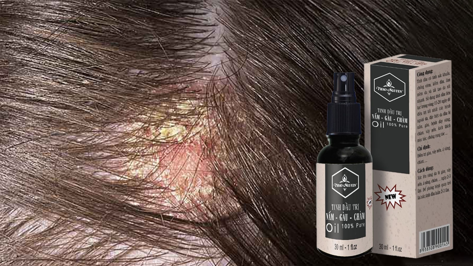 Tinh Dầu Trị Nấm - Gàu - Chàm 30ml