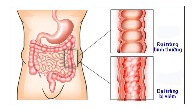 Bệnh viêm đại tràng